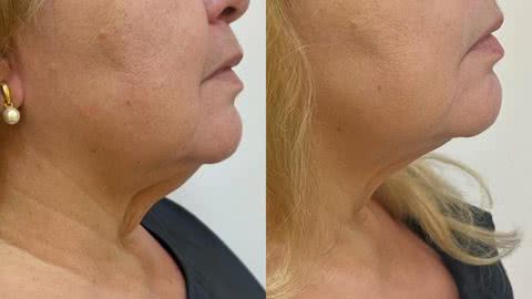 O Endolifting é um procedimento minimamente invasivo que trata a flacidez e a gordura facial e de pescoço - Créditos: Arquivo Dra. Erika Kugler