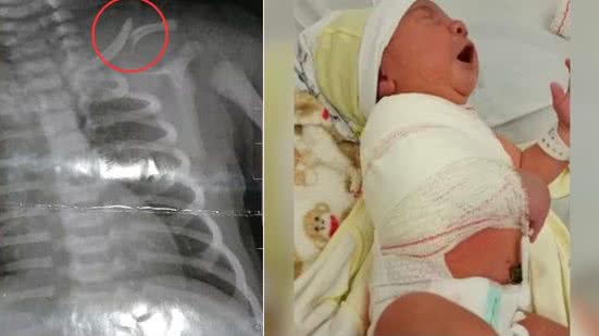 Bebê tem clavícula fraturada durante parto e mãe é denunciada ao Conselho Tutelar; entenda - Imagem: Reprodução | Acervo g1