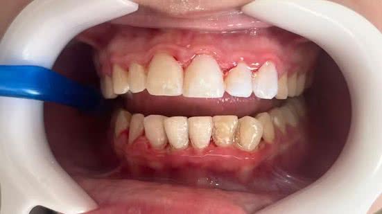 Dentes desgastados e desenvolver necrose pulpar e óssea (morte da polpa dentária e dos ossos) após a aplicação de lentes de resina - Imagem: Arquivo Pessoal e g1