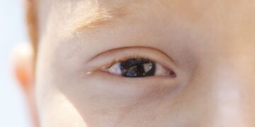 Erros de refração são principal causa de deficiência visual infantil