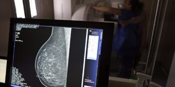 Ministério da Saúde passa a recomendar mamografia a partir dos 40 anos