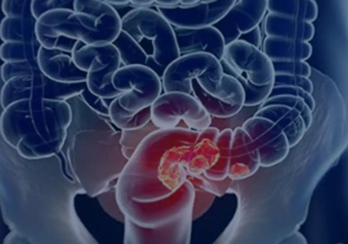 Pacientes com câncer colorretal são diagnosticados em estágio avançado