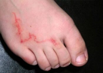 Como evitar bicho-geográfico e outras infecções de pele na areia