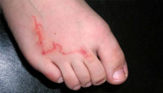 Como evitar bicho-geográfico e outras infecções de pele na areia